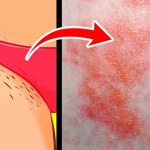 Diaper rash in the groin in women