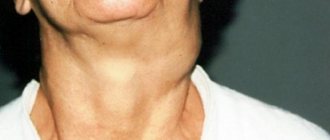 Tumors and swellings in the neck area