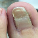 Complications after ingrown toenail surgery