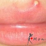 The main causes of rashes on the upper lip