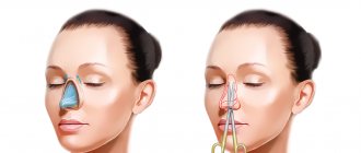 Open and closed rhinoplasty