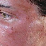 Burn on the face after salicylic acid