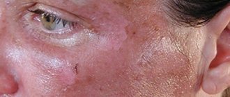 Ожог на лице после салициловой кислоты