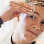Teenage acne in boys