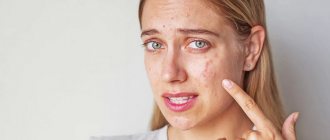 Acne appeared on the face during pregnancy