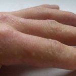 What diseases cause blisters to appear under the skin on the fingers?
