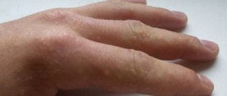 При каких болезнях появляются пузырьки под кожей на пальцах рук