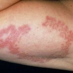 causes of armpit fungus
