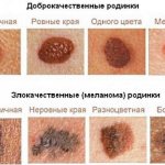 Причины и лечение пятен на коже коричневого цвета: на спине, ногах, руках, животе. Фото