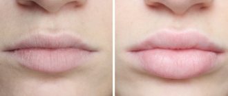 An example of lip augmentation using fillers. Comparison with tattoo 