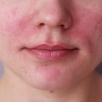 The problem of red spots on the skin