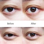 Problems of the eyelid area