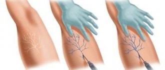 Microsclerotherapy procedure for telangiectasis
