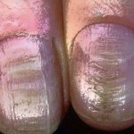 Продольные борозды на ногтях рук и ног