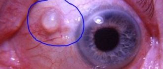 Pimple on the eyeball and near the pupil photo