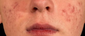 Pimples without pus on the face: large, red, subcutaneous, do not go away photo