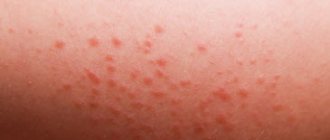 Acne on the inner thigh in women: causes and types of photos