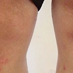 Psoriatic rashes in the knee area
