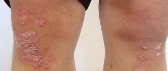 Psoriatic rashes in the knee area