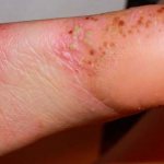 Psoriasis in the foot area