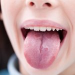 Tongue cancer
