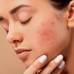 Common foods that cause acne
