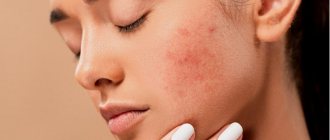 Common foods that cause acne