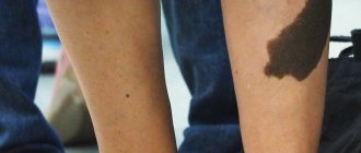 birthmarks on leg photo
