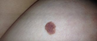 Mole on the left breast in women