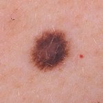 A mole with uneven color is not always cancer.