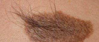 Moles, or pigmented nevi, occur in 90% of people