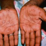 syphilitic rash photo in men