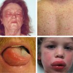 Симптомы лекарственной аллергии