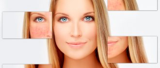 spider veins on the face treatment