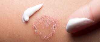 remedies for atopic dermatitis