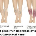 Stages of development of trophic ulcers on the legs
