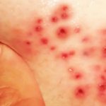 Staphylococcus and acne on the face: treatment, photo of Staphylococcus aureus photo