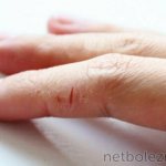 Dry hand skin