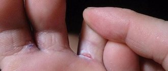 Трещины на пальцах ног