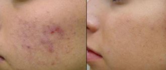 Tretinoin and acne