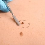 Removal of moles and papillomas