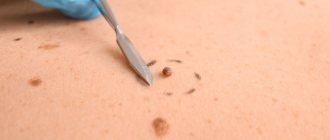 Removal of moles and papillomas