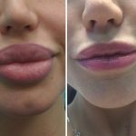 lip reduction