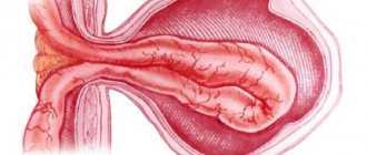 Types of inguinal hernia