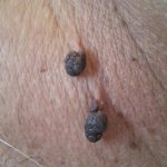 hanging moles on the labia