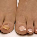 Yellow nails on one foot of a woman