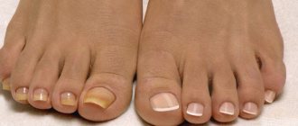 Желтые ногти на одной ноге у женщины