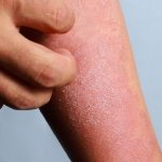 ITCHING OF THE SKIN WITH DERMATITIS