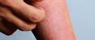ITCHING OF THE SKIN WITH DERMATITIS